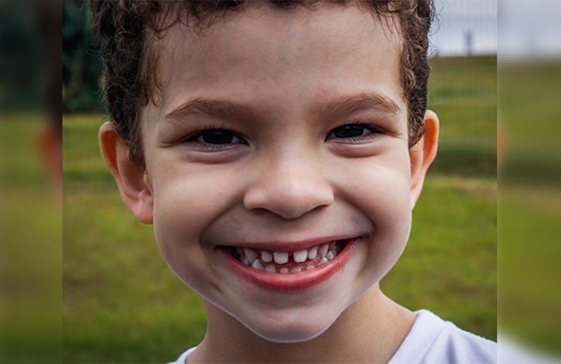 Child smiling with his teeth showing.
