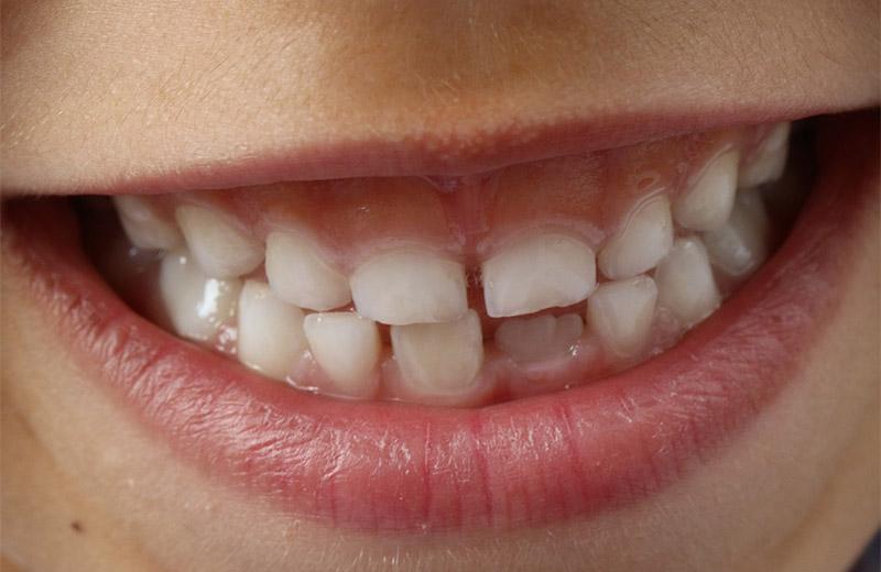 Smiling showing teeth